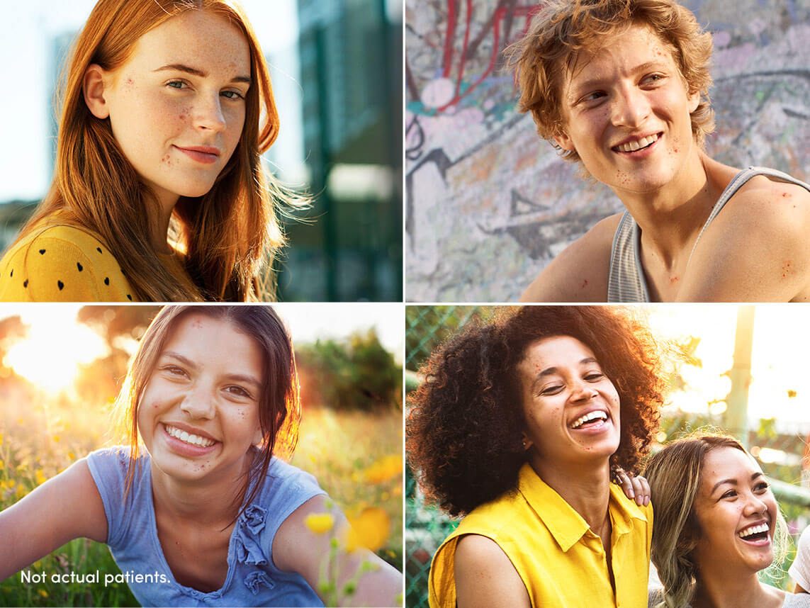 4 image collage of smiling patients with clearer skin represents AKLIEF® (trifarotene) Cream treating different skin types