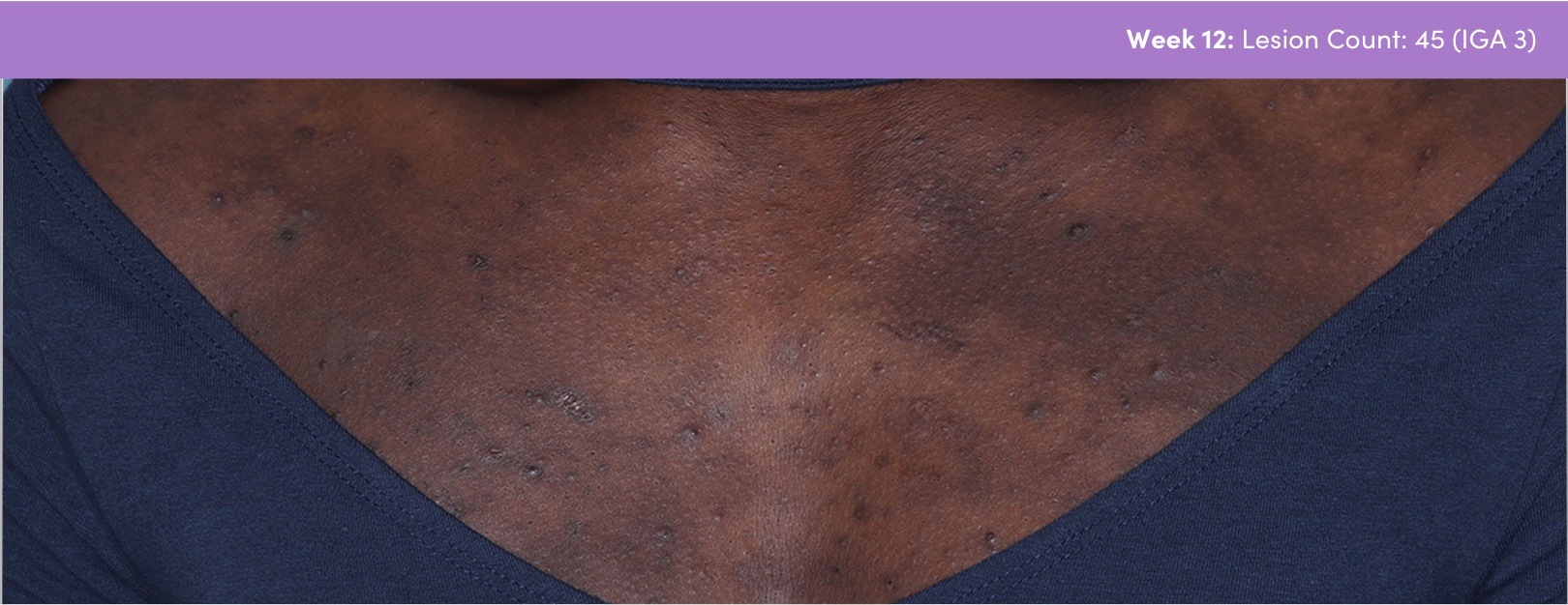 Photo of skin of color chest acne vulgaris after AKLIEF® (trifarotene) Cream acne vulgaris treatment. Lesion count 45