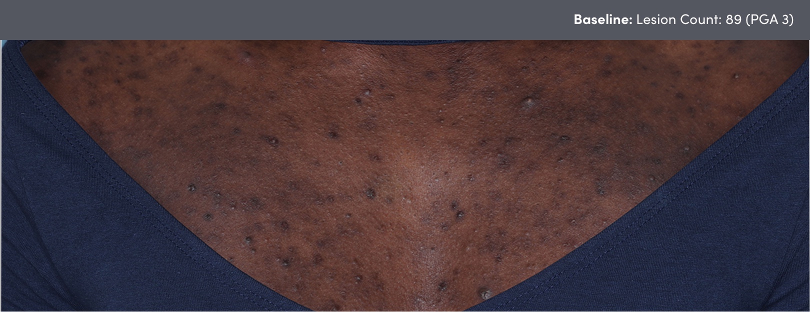 Photo of skin of color chest acne vulgaris before AKLIEF® (trifarotene) Cream acne vulgaris treatment. Lesion count 89