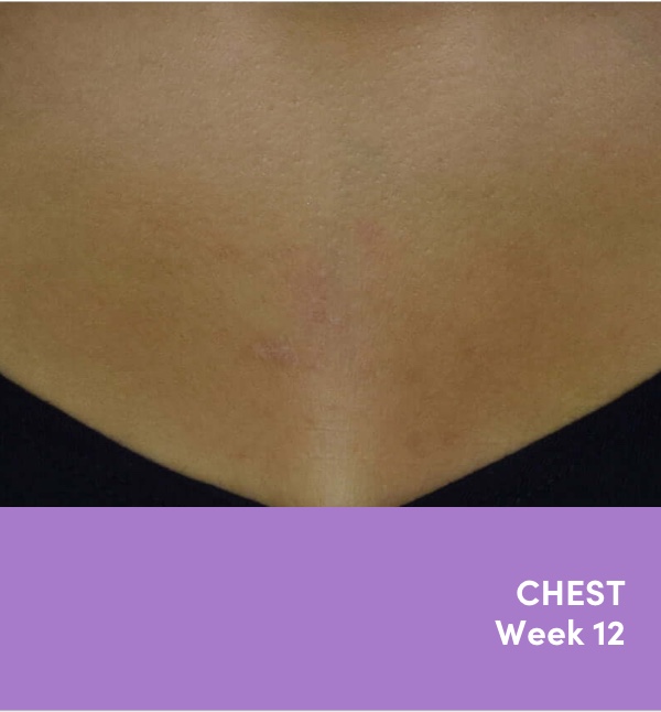 16 year old teen female chest acne photo after AKLIEF® (trifarotene) Cream prescription acne treatment