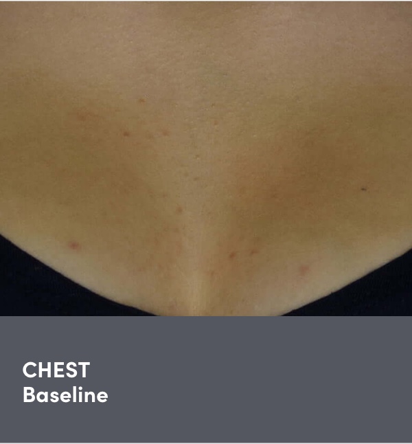16 year old teen female chest acne photo before AKLIEF® (trifarotene) Cream prescription acne treatment