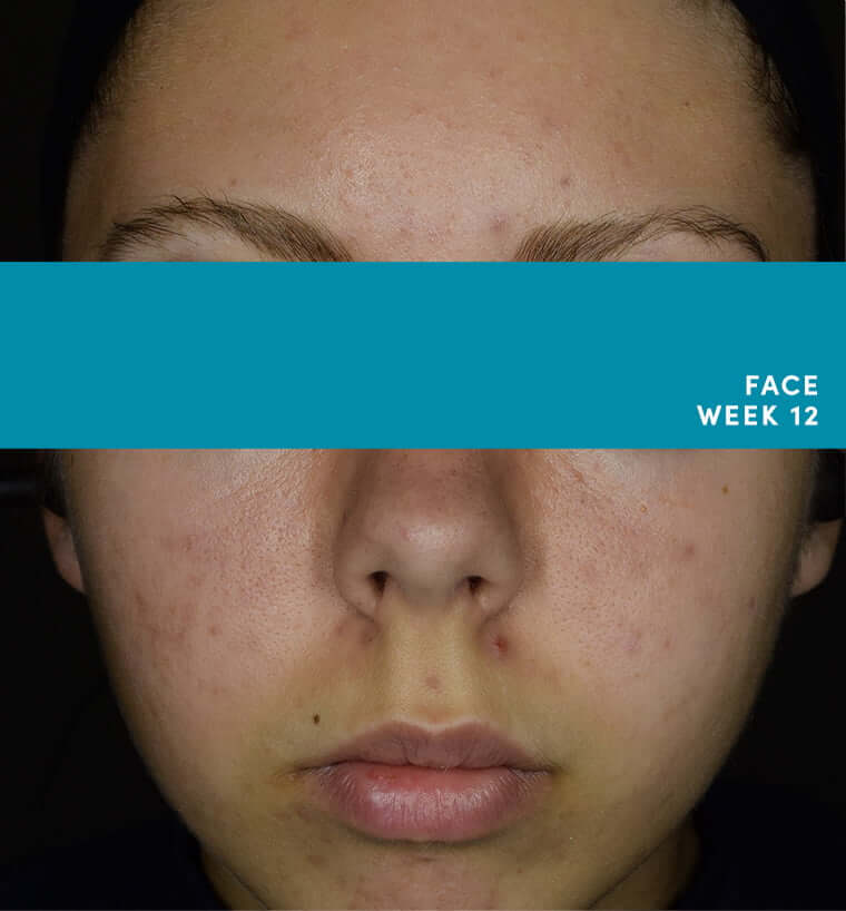 prescription acne treatment for teens aklief trifarotene cream
