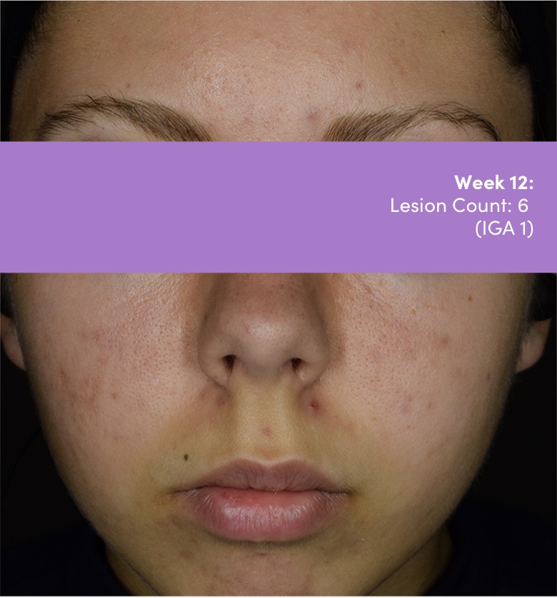 16 year old female photo of face acne vulgaris after AKLIEF® (trifarotene) Cream acne vulgaris treatment. Lesion count 6