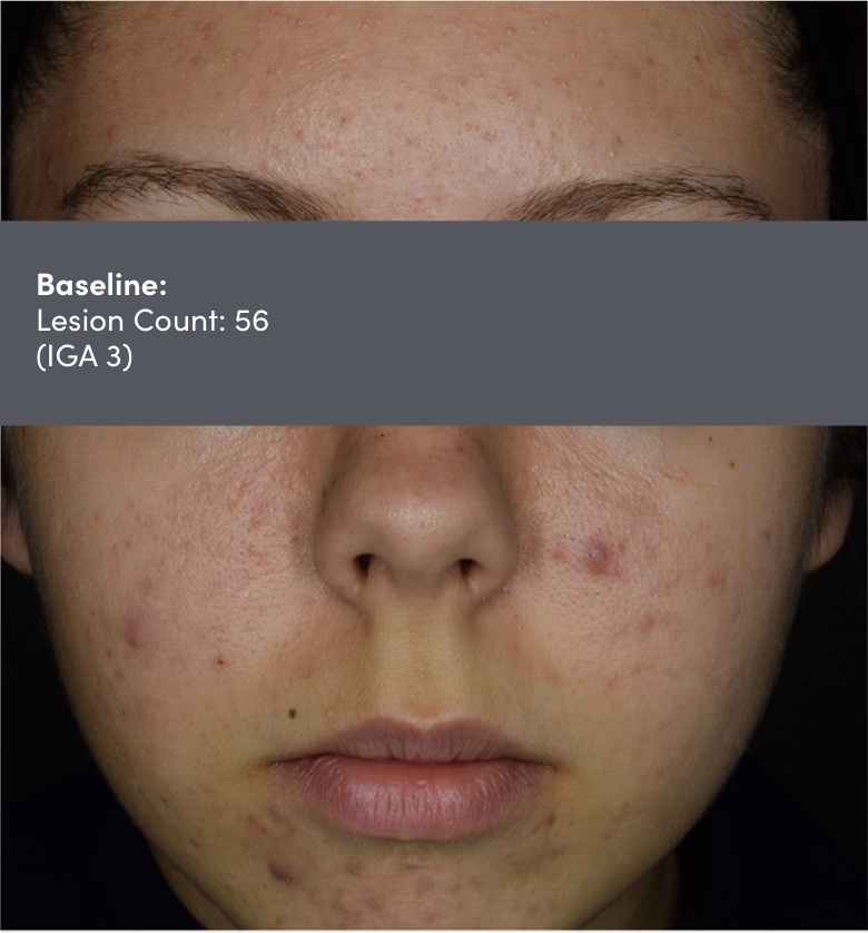 16 year old female photo of face acne vulgaris before AKLIEF® (trifarotene) Cream acne vulgaris treatment. Lesion count 56