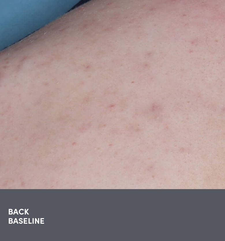 14 year old teen male back acne photo before AKLIEF® (trifarotene) Cream prescription acne treatment