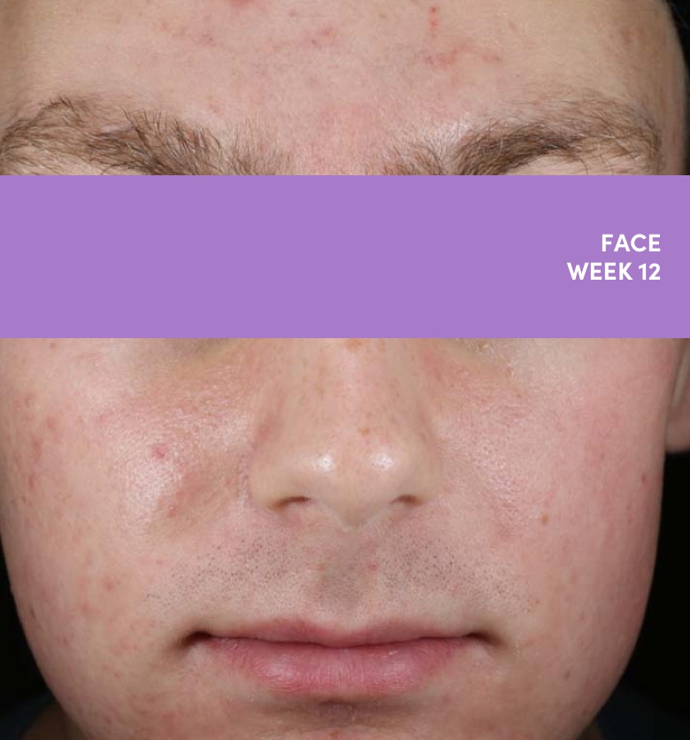 16 year old teen male face acne photo after AKLIEF® (trifarotene) Cream prescription acne treatment
