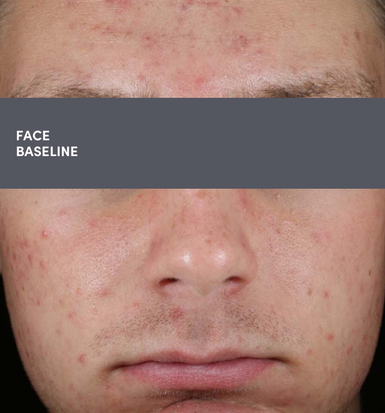 16 year old teen male face acne photo before AKLIEF® (trifarotene) Cream prescription acne treatment