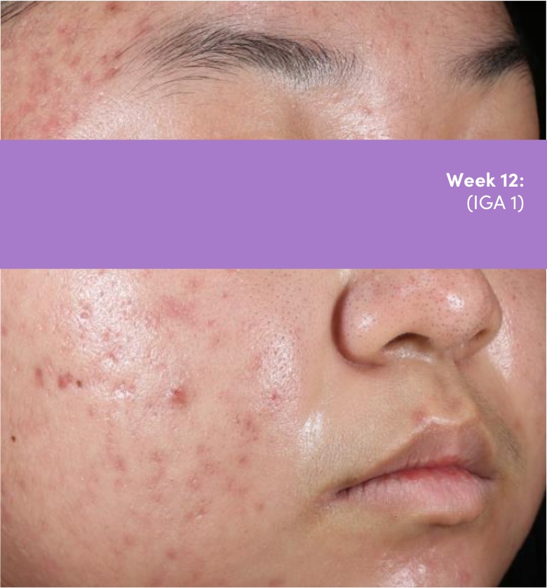 Male photo of face acne vulgaris after Dual Study of AKLIEF® (trifarotene) Cream and doxycycline acne vulgaris treatment