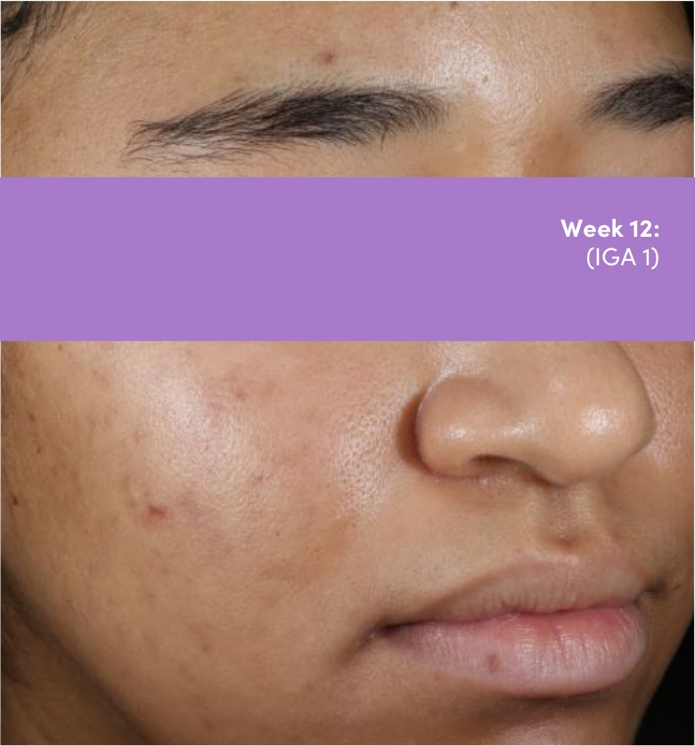 Male photo of face acne vulgaris after Dual Study of AKLIEF® (trifarotene) Cream and doxycycline acne vulgaris treatment