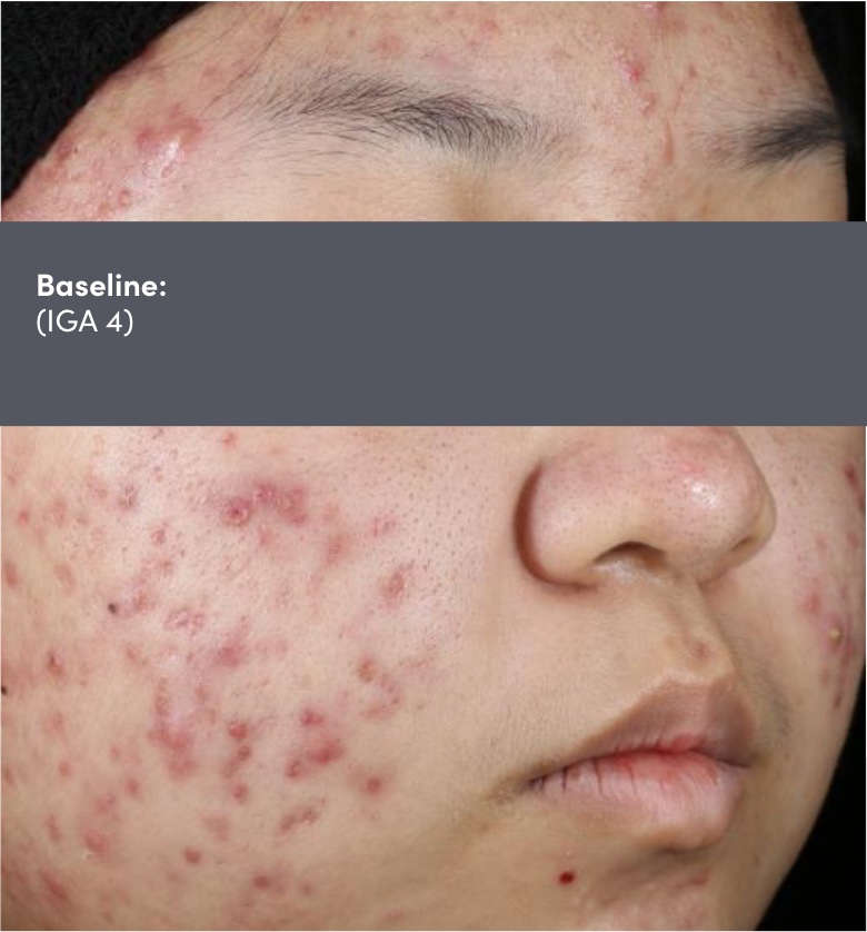 Male photo of face acne vulgaris before Dual Study of AKLIEF® (trifarotene) Cream and doxycycline acne vulgaris treatment