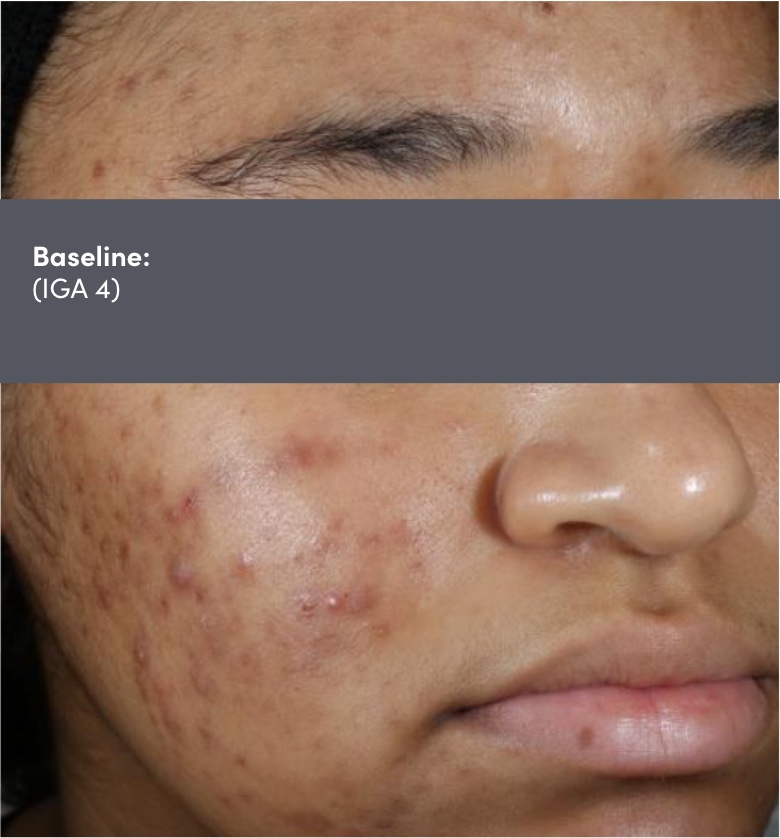 Male photo of face acne vulgaris before Dual Study of AKLIEF® (trifarotene) Cream and doxycycline acne vulgaris treatment