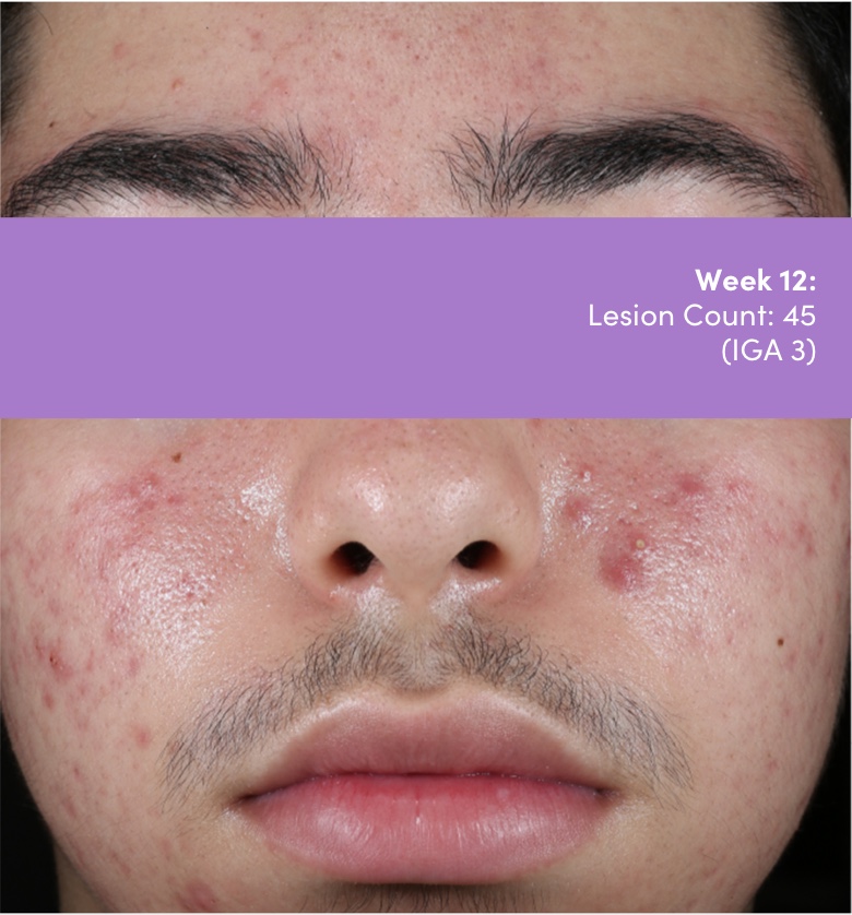 Male photo of face acne vulgaris improvements after AKLIEF® (trifarotene) Cream acne vulgaris treatment. Lesion count 45