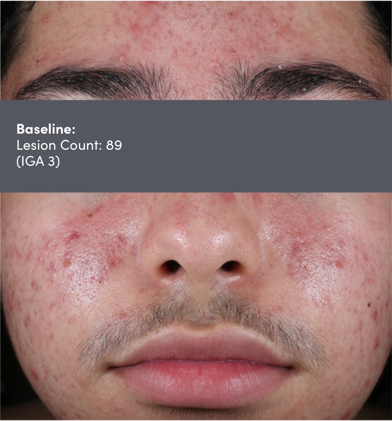 Male photo of face acne vulgaris before AKLIEF® (trifarotene) Cream acne vulgaris treatment. Lesion count 89