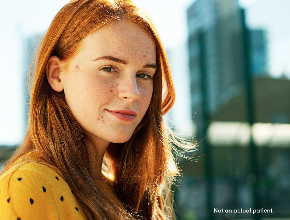 Young female that may benefit from AKLIEF® (trifarotene) Cream. In clinical trials 55% of the >2000 patients were females