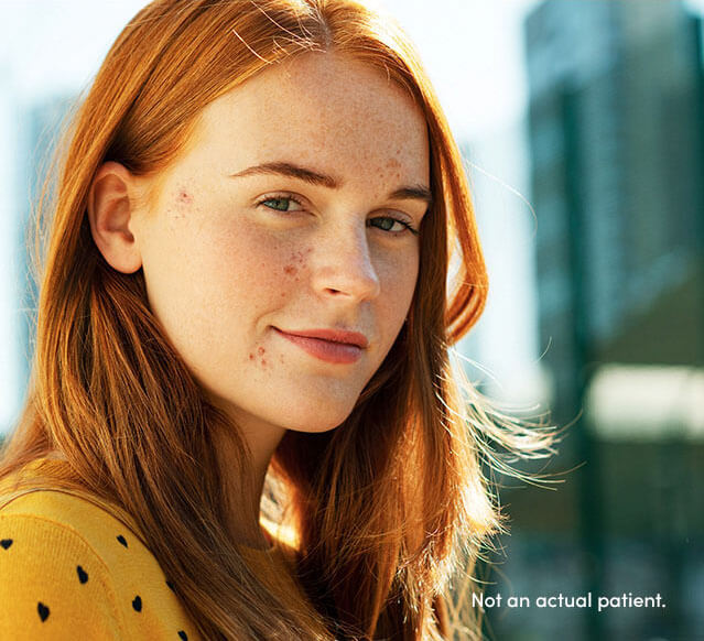 Young female that may benefit from AKLIEF® (trifarotene) Cream. In clinical trials 55% of the >2000 patients were females