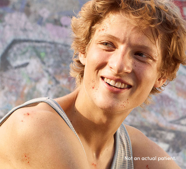 Teenagers may benefit from AKLIEF® (trifarotene) Cream. In clinical trials 47% of patients were teens 12-17 yrs old