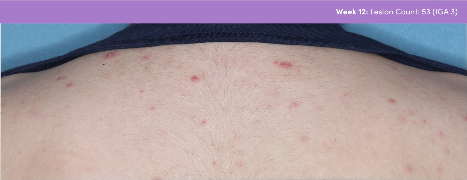 Photo of truncal acne vulgaris improvements after AKLIEF® (trifarotene) Cream acne vulgaris medication